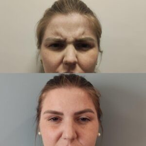 Botox facial em Campinas