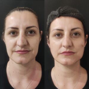 Harmonização facial em Campinas