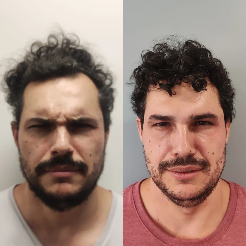 Harmonização facial masculina em Campinas