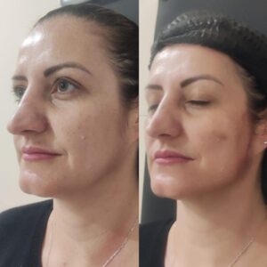 Lifting facial em Campinas