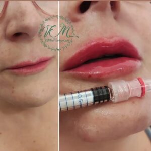 Preenchimento labial em Campinas