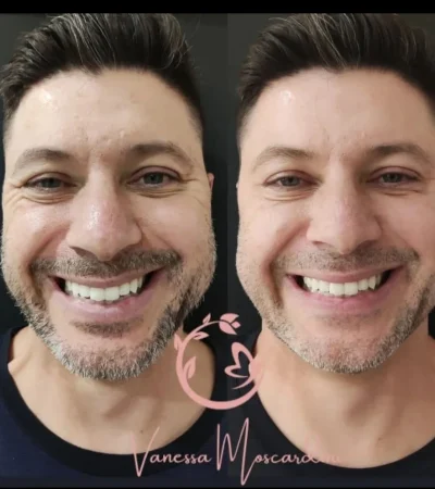 Harmonização facial masculina